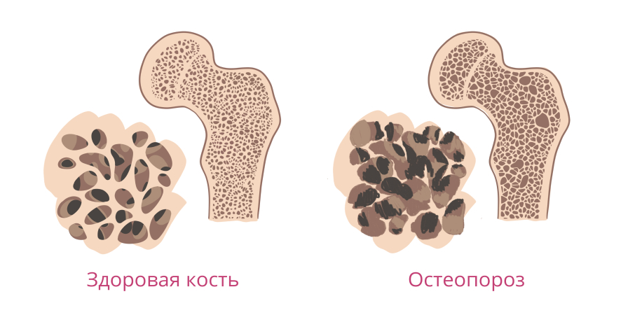 Стероидные гормоны, миома матки и нарушения функции печени: патогенез и перспективы лечения